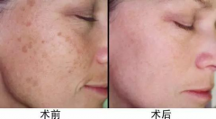 超皮秒價格，超皮秒廠家哪個比較好？