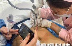 妊娠紋用什么儀器能去除？妊娠紋修復(fù)儀器廠家_最新祛妊娠紋的儀器